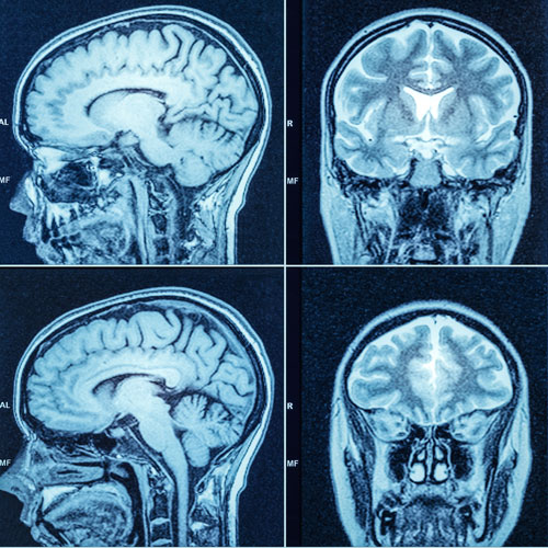 Brain CT Scan Radiology Images