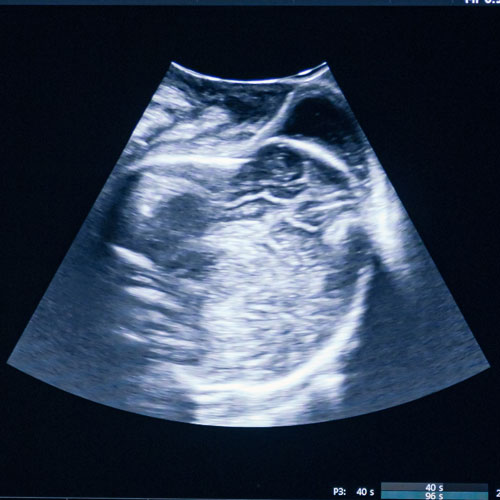 Prenatal Ultrasound Radiology Image