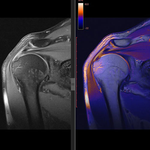 Shoulder MRI Radiology Image